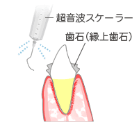 歯周治療